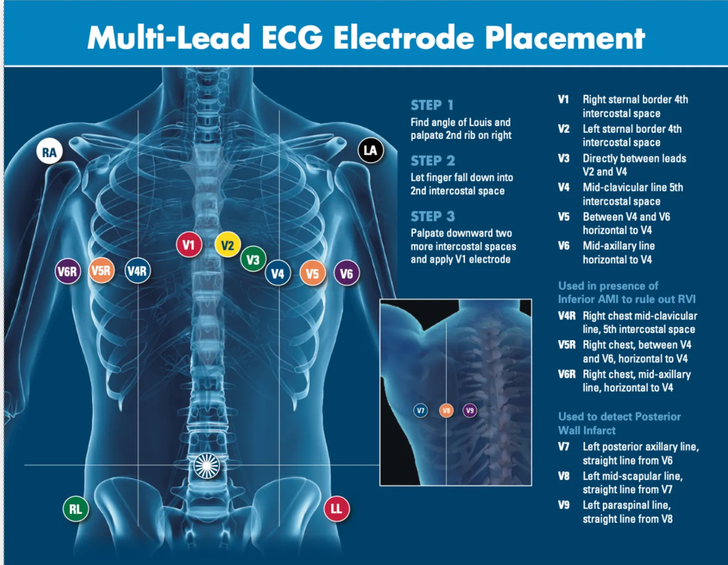 Multi-lead ECG electrode placement diagram showing proper positioning