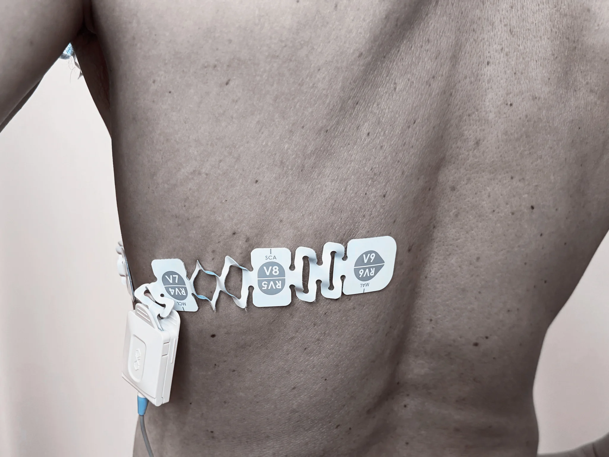 EXG Posterior 3-Lead Configuration