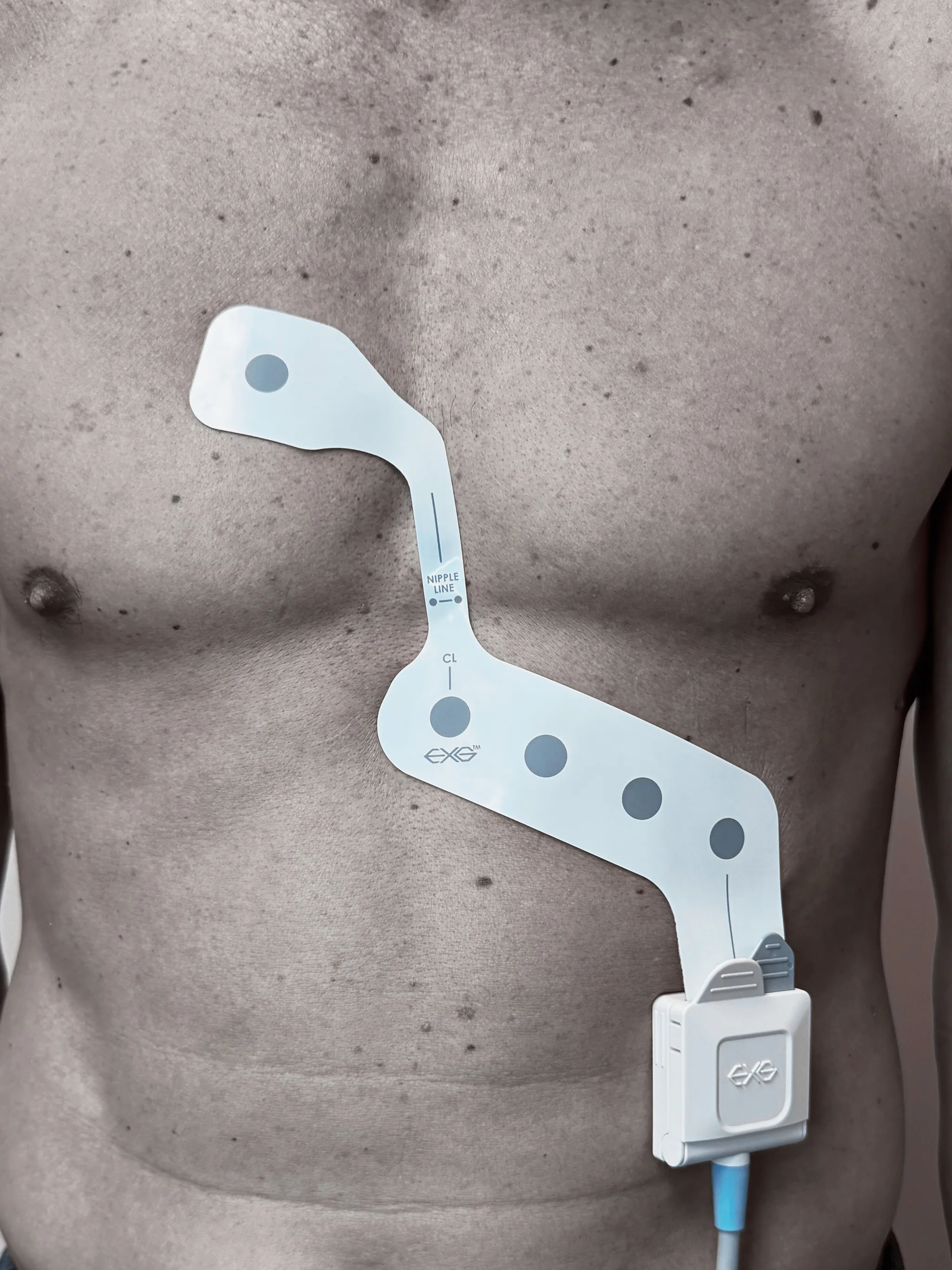 EXG 5-Lead Configuration