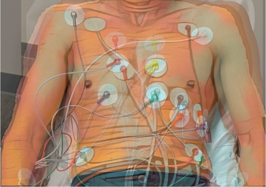 ACEP 2023 Poster — Before and After ECG Comparison